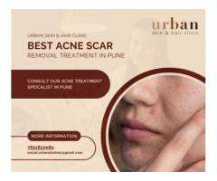 Effective Acne Scar Treatment in Pune by Dr. Kiran